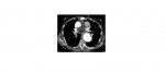 Axial CT chest slice