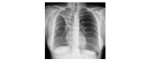 Frontal chest xray