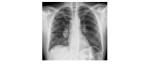 pulmonary nodule