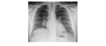 PA chest x-ray