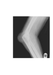 Right elbow x-ray