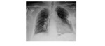 Chest x-ray AP
