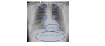Review areas on a chest x-ray