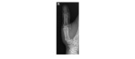 Right thumb x-ray