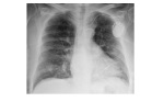 chest x-ray AP view