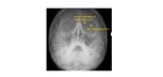 Facial X-Ray orbital emphysema