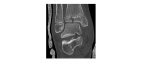 Right ankle CT