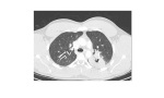 CT chest lung window 1