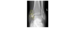 Comminuted medial malleolus fracture
