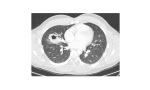 Ct chest lung window 2