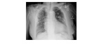 chest x-ray frontal view