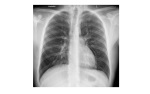 Chest x-ray 1