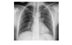 Chest x-ray 2