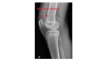 Knee joint effusion