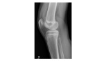 Right knee HBL x-ray
