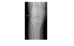 Right knee frontal x-ray