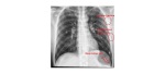 Deep sulcus sign of supine pneumothorax