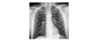 supine chest x-ray 1