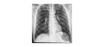 supine chest x-ray 2