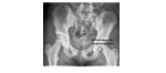 Ischial tuberosity avulsion fracture