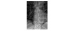 Thoracic spine frontal x-ray