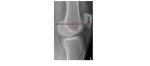 Lateral femoral notch sign