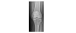 Left knee x-ray