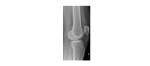 Left knee x-ray lateral view