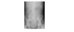 Supine abdominal x-ray