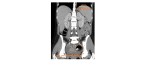 coronal CT pneumoperitoneum