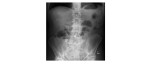 Erect abdominal x-ray