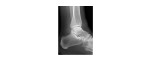 Left ankle lateral view