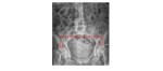 bilateral neck of femur fractures