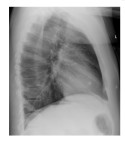 Lateral chest x-ray
