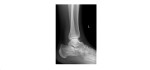 Left ankle lateral x-ray