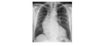 PA chest x-ray