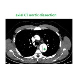 axial CT aortic dissection