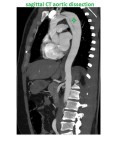 sagittal CT aortic dissection