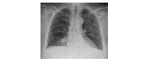chest x-ray PA view