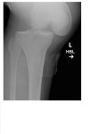 left knee x-ray 1