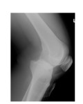 left knee x-ray 2