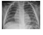 AP chest x-ray