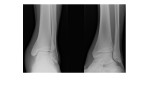 Left ankle x-rays