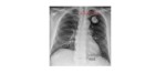 pulmonary hamartoma