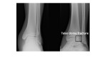 talar dome fracture