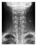 C-Spine x-ray AP