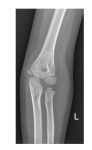 Left elbow frontal x-ray 1