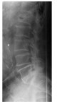lumbar spine x-ray lateral