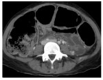 Axial CT abdomen