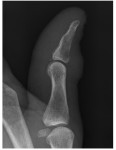 Lateral x-ray left thumb